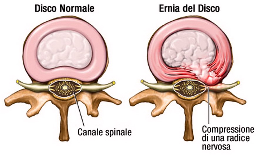 ernia del disco